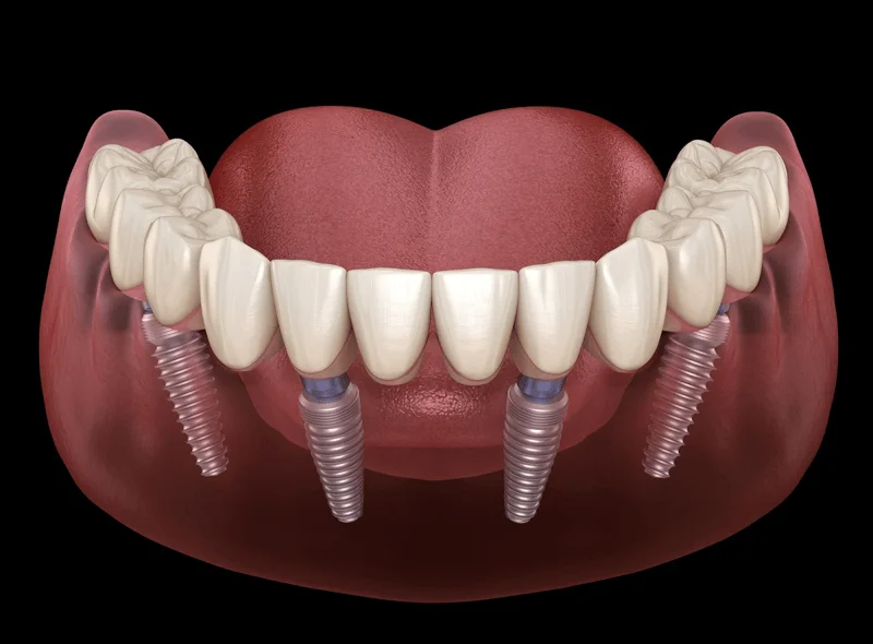 all-on-4-dental-implants-treatment-at-Indiadens